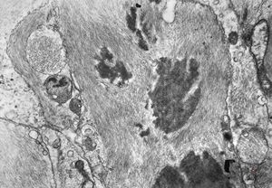 M,11y. | fibrillary astrocytoma M,11y. | fibrillary astrocytoma